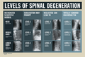 Levels of Spinal Degeneration