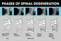 Spinal Degeneration