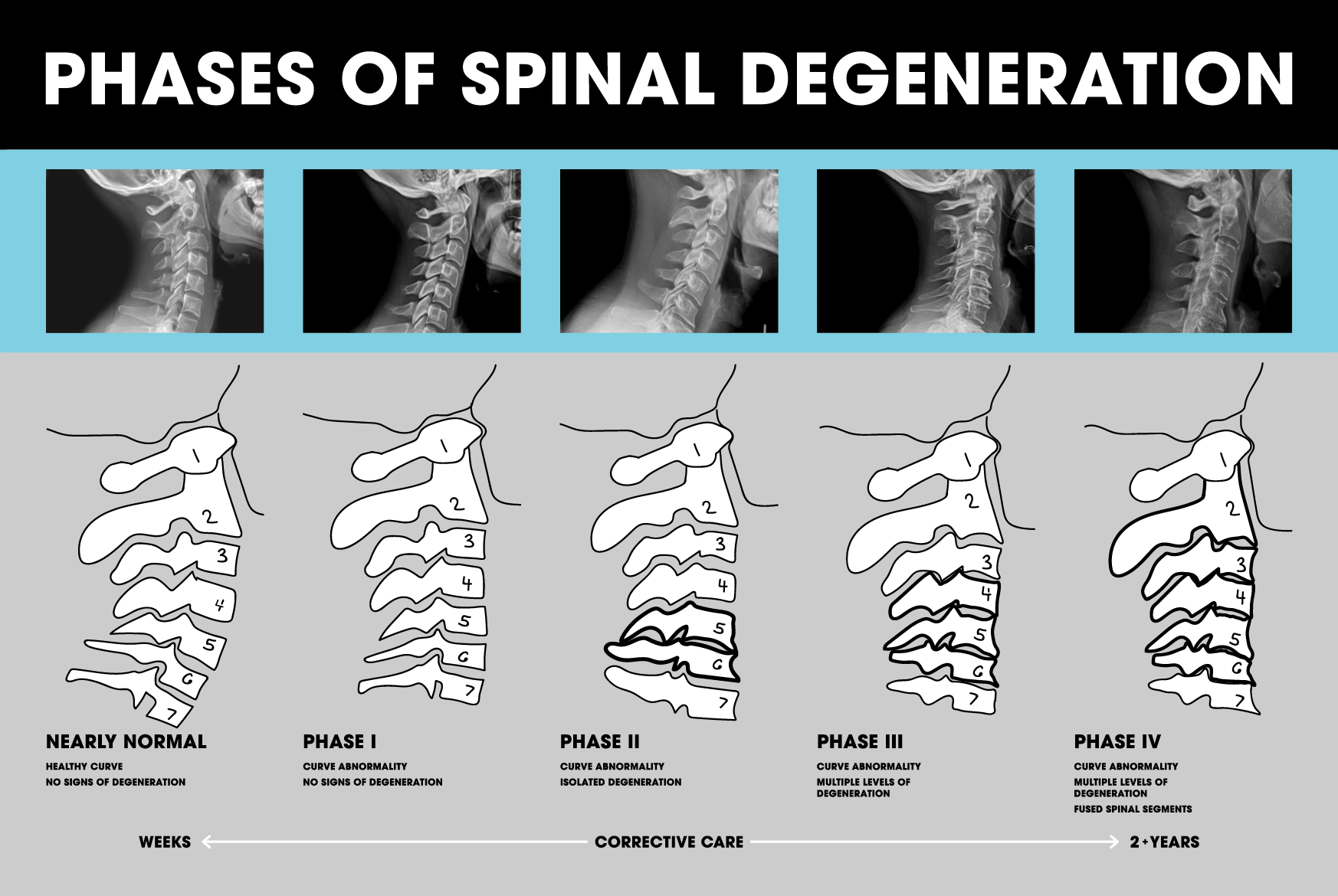 Spinal Degeneration