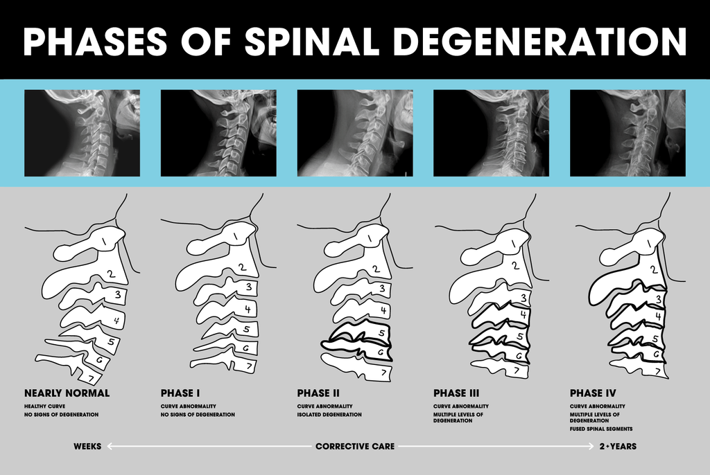 Spinal Degeneration
