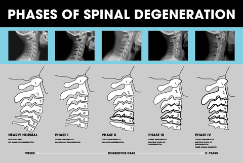 Spinal Degeneration